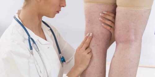 Various Symptoms of Deep Vein Thrombosis Worth Knowing