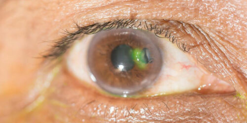 Various eye diseases and their symptoms