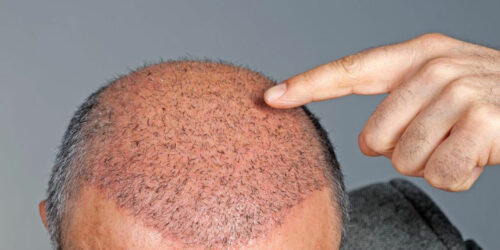 Hair Transplant Cost and Procedure