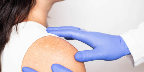 Vitiligo – Signs, Causes, and Management Remedies