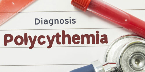 Various Aspects of Polycythemia Vera