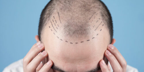 Hair Transplant &#8211; Techniques, Costs, and More