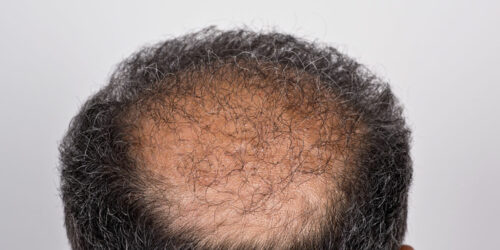 Hair Transplant &#8211; Types, Procedure, and Cost