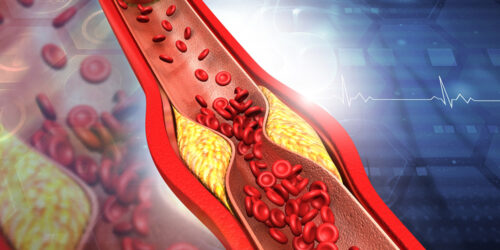 8 Ways to Manage Plaque in Arteries